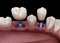 Premolar and Molar tooth crown installation over implant - concept. 3D illustration of human teeth