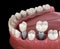 Premolar and Molar tooth crown installation over implant - concept. 3D illustration of human teeth