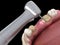 Premolar preparation process for dental crown placement. Medically accurate 3D illustration