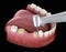 Premolar preparation process for dental crown placement. Medically accurate illustration