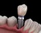 Premolar tooth recovery with implant. Medically accurate 3D illustration of human teeth and dentures