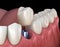 Premolar tooth recovery with implant. Medically accurate 3D illustration of human teeth and dentures