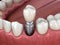 Premolar tooth recovery with implant. Medically accurate 3D illustration of human teeth and dentures