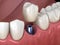 Premolar tooth recovery with implant. Medically accurate 3D illustration of human teeth and dentures