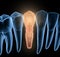 Premolar tooth recovery with implant, x-ray view. Medically accurate 3D illustration of human teeth and dentures