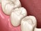 Premolar tooth restoration with filling. Medically accurate tooth illustration