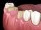 Preparated molar and premolar tooth for dental bridge placement. Medically accurate illustration