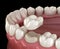 Preparated molar tooth for dental crown placement. Medically accurate illustration