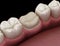 Preparated molar tooth for dental crown placement. Medically accurate illustration