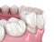 Preparated premolar tooth and dental crown placement. Medically accurate 3D illustration