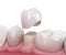 Preparated premolar tooth and dental crown placement. Medically accurate 3D illustration