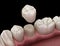 Preparated premolar tooth for dental crown placement. Medically accurate illustration