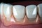 Pressed ceramic veneers create a pearly white smile