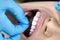 Pretty woman`s teeth cleaning in dental clinic
