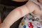 Prickly heat. Close-up of the folds of the hand of a newborn baby with red skin.