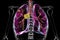 Primary lung tuberculosis, 3D illustration