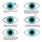 Procedure of laser correction of vision step by step. Infographics