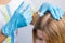 Procedure of mesotherapy. The doctor cosmetologist making injections in woman`s head for stronger and healthier hair