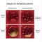 Process of cholesterol forming plaque in artery