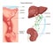 Process of metastasis. Formation of tumor in a tissue of secondary