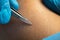 process of permanent hair removal, removing unwanted hair using an tweezers, close-up macro photography. Cosmetology