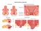 Proctological diseases set. Large intestine and rectum disorders