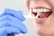 Professional deep tooth cleaning with dental floss