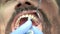 Professional teeth cleaning close up.