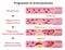 Progression of arteriosclerosis illustration