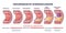 Progression of atherosclerosis and thrombosis formation outline diagram