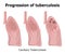 Progression of tuberculosis