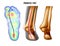 Pronated foot, arch deformation, bottom and back view . Foot weight distribution.