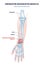 Pronator quadratus muscle with right hand anterior view outline diagram