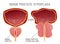 Prostate Disease Infographic
