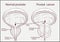 Prostatic hypertrophy