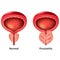 Prostatitis normal and inflamed prostate isolated vector