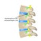 Protrusion of the intervertebral disc. Vector illustration on isolated background