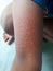 Pruritus, skin rash in children, allergy