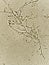 Pseudohyphae and budding yeast cells in urine