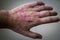 Psoriasis. autoimmune skin disease. man& x27;s hand with pockets of psoriasis lesion on a gray background