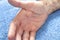Psoriasis disease on the man`s hand.