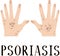 Psoriasis. Diseased skin. Sore hands. Medical poster. Dermatology and venereology