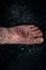 Psoriasis eczema on the foot Man itching skin Psoriasis scales are scattered on black background.