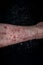 Psoriasis eczema on the foot Man itching skin Psoriasis scales are scattered on black background.