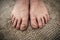 Psoriasis in the foot