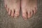 Psoriasis in the foot