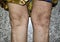 Psoriasis or Fungal Infection called Tinea Corporis on knees of Southeast Asian, Burmese adult woman.