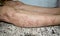 Psoriasis or Fungal Infection called Tinea Corporis on leg of Southeast Asian, Burmese adult woman.