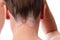 Psoriasis on the hairline and on the scalp