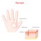 Psoriasis of human hand. Symptoms of disease